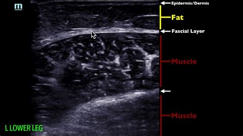 ultrasound for soft tissue